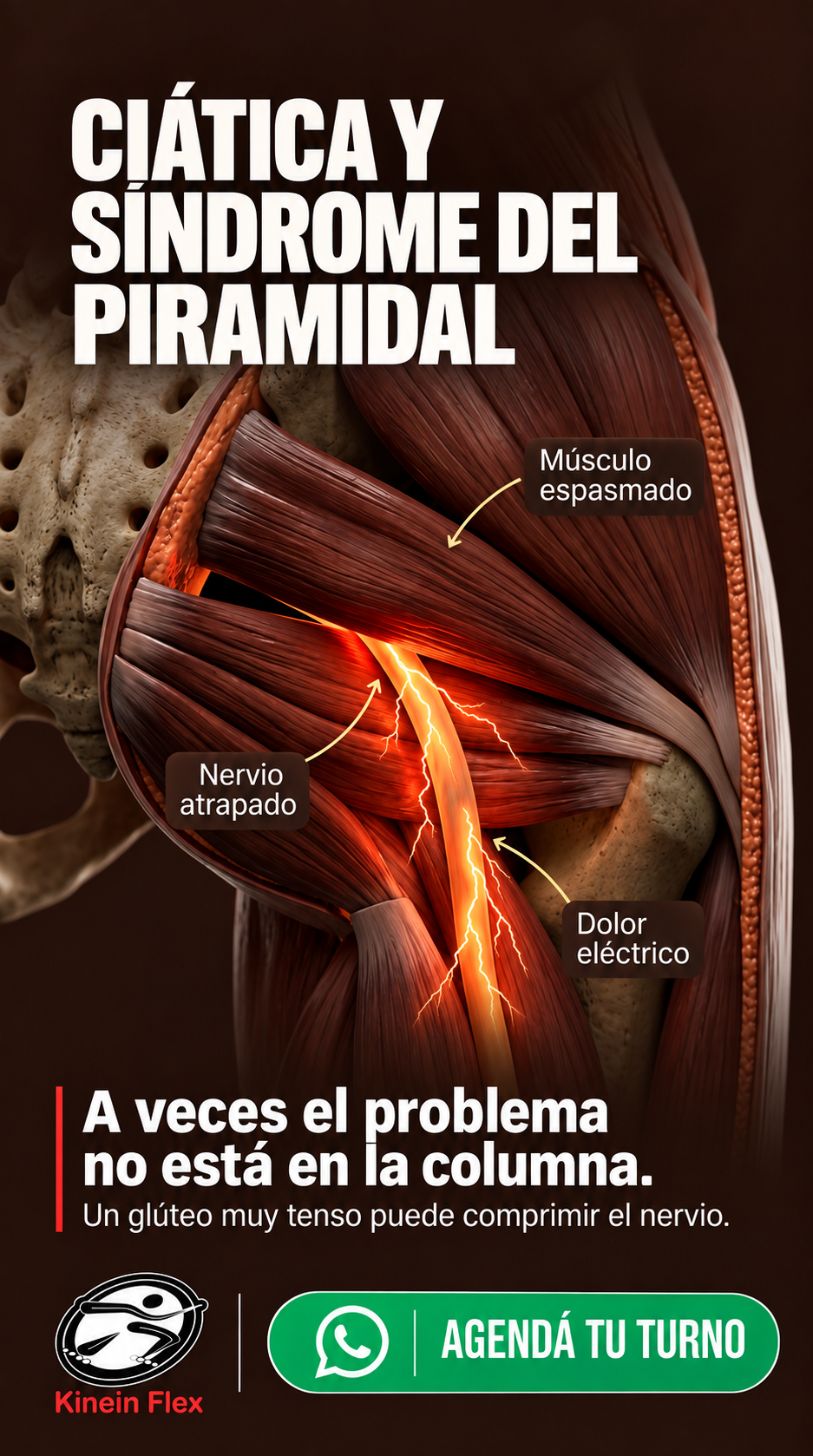 Publicación de Kinein Flex sobre síndrome del piramidal e irritación del nervio ciático